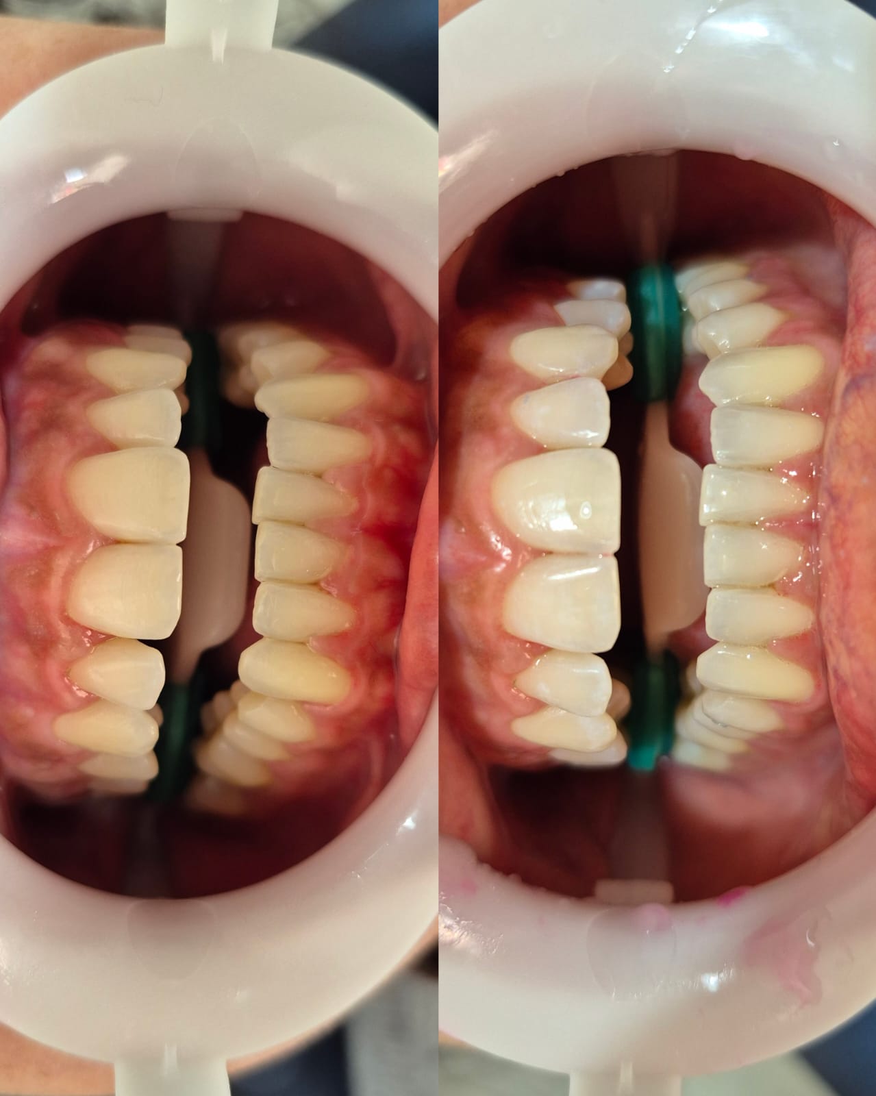 Resultado de clareamento e alinhamento dental